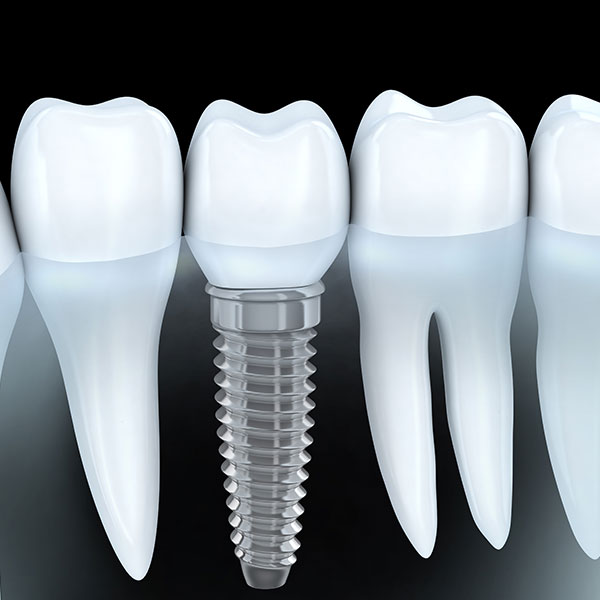 人工植牙<span>Implant</span> 人工植牙<span>Implant</span>