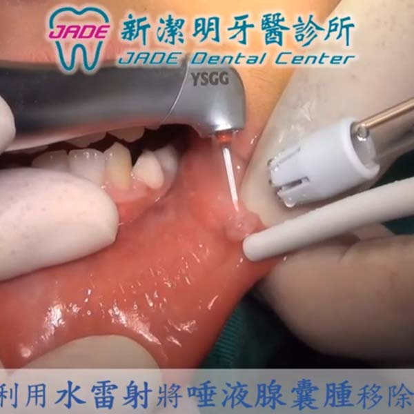 雷射微創治療 雷射微創治療